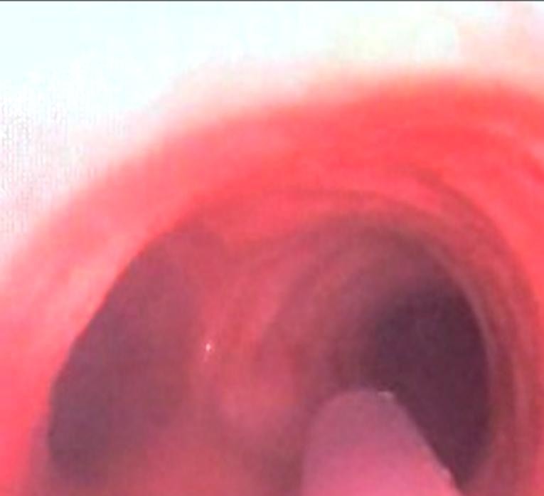 Endoscopic view inside the human trachea as captured by the ET-View integrated camera